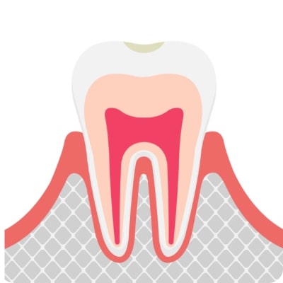 初期の虫歯