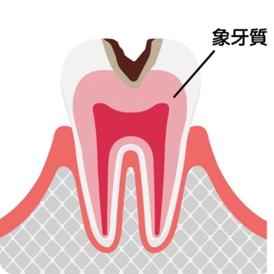 中間虫歯