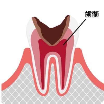 深部虫歯