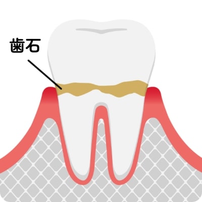 歯周炎