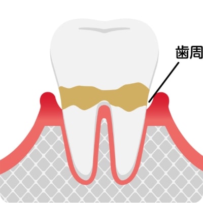 軽度の歯周炎