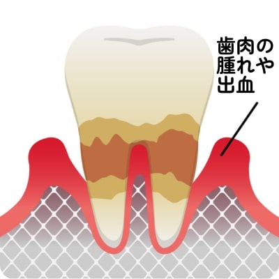 中度の歯周炎