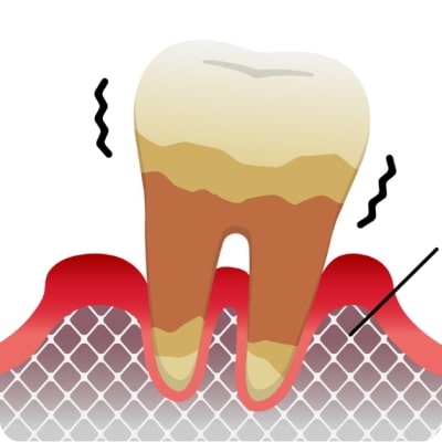重度の歯周炎